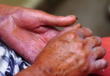 La lepra no desapareció: seis nuevos casos detectados en Nayarit