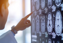 Identifican una proteína que podría explicar por qué el cerebro no recupera el flujo sanguíneo tras un ACV