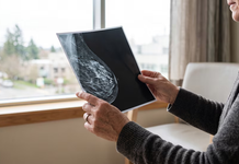 Cáncer de mama inflamatorio: las señales en la piel que pueden confundirse con mastitis